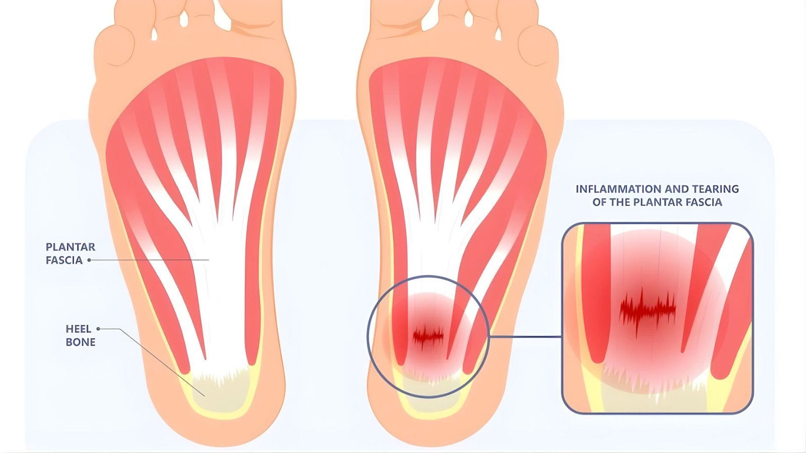 Understanding Plantar Fasciitis