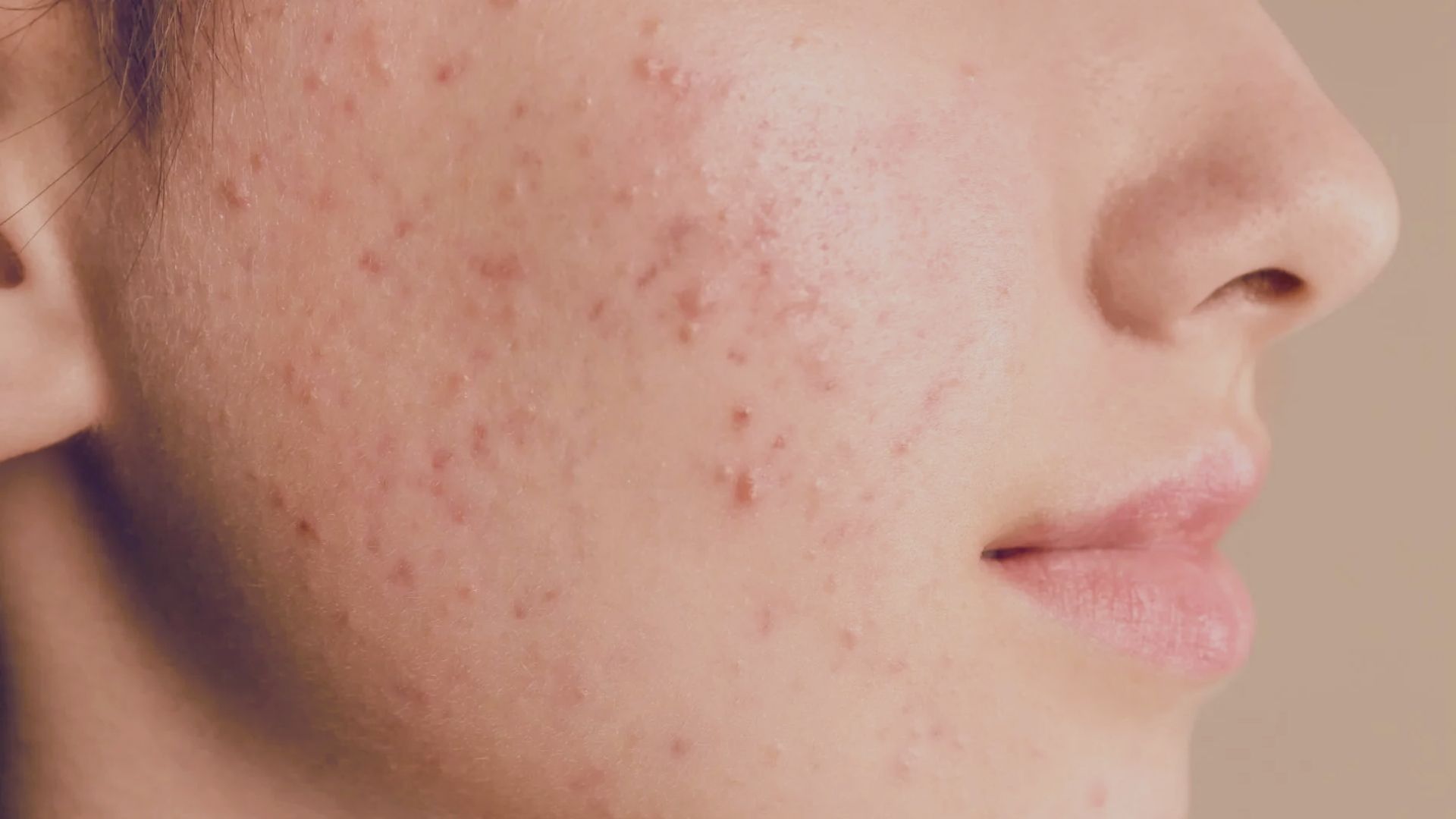 Visual representation of acne, a prevalent skin issue linked to multiple causes, such as pre-workout activities.