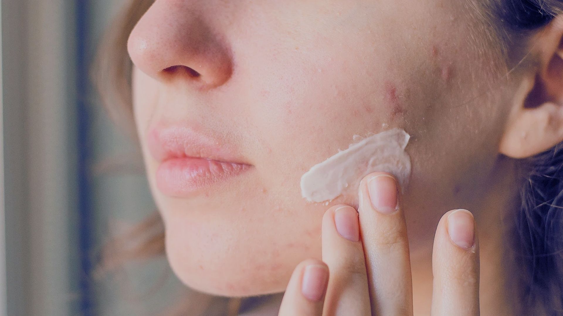 A woman is applying cream to her face, emphasizing acne prevention as part of her skincare routine.