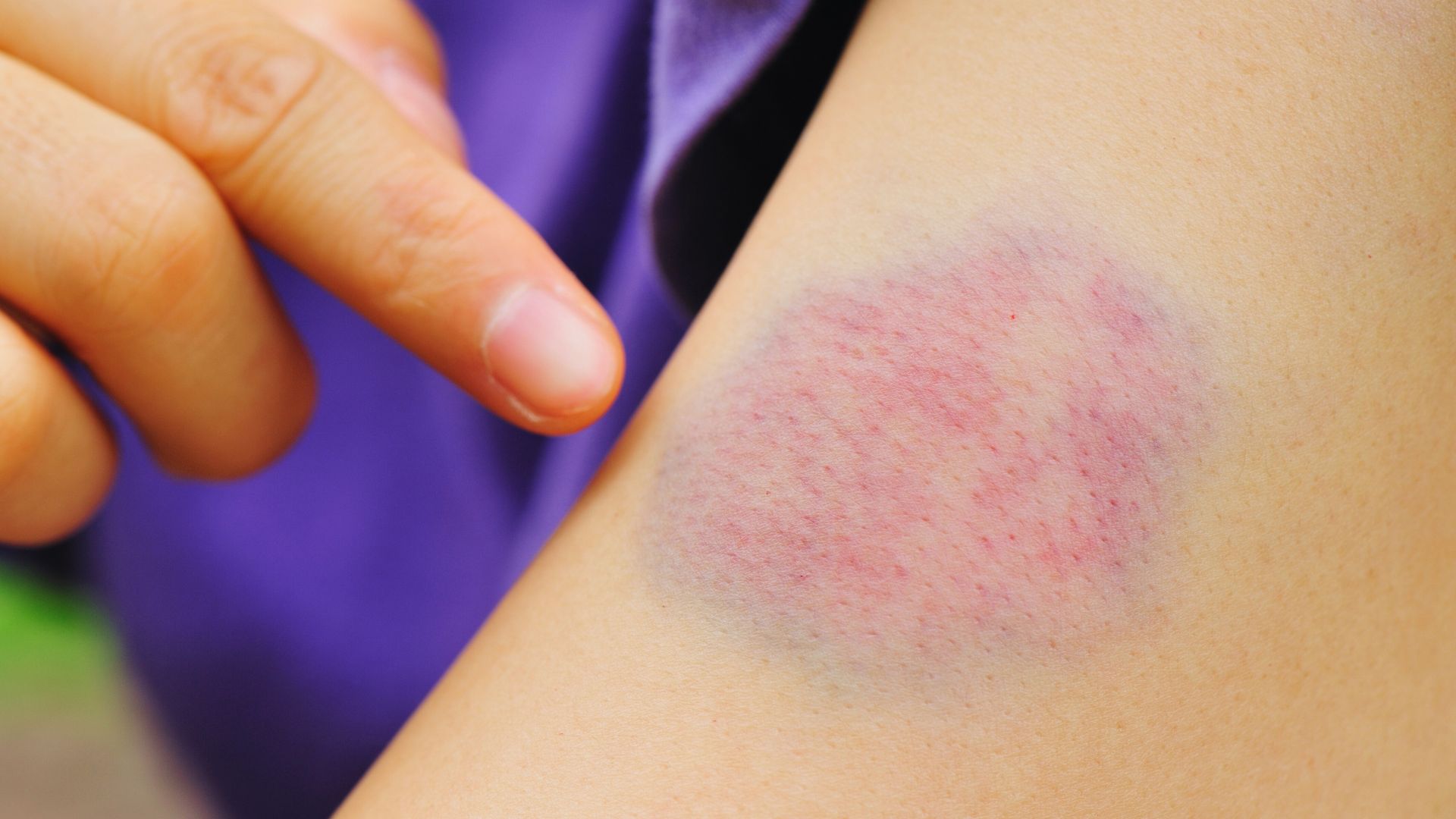 A finger points to a large purple and red bruise on an arm, highlighting the injury's severity against a background of purple fabric.