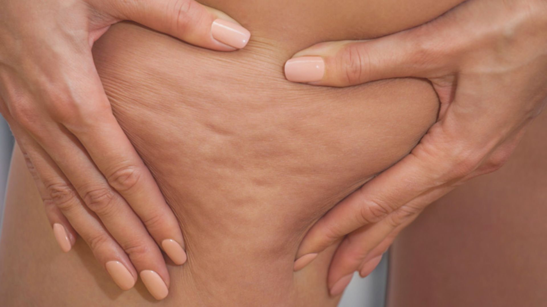 Hands with nude nails pinch thigh skin, revealing cellulite texture. The tone is intimate and focused, highlighting natural body details.