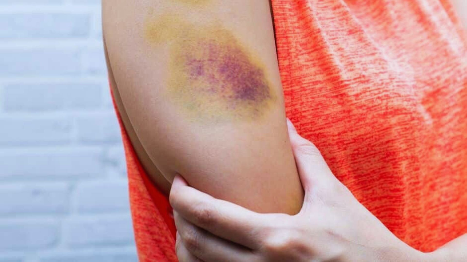 A person wearing a bright orange shirt gently holds their arm, which shows a large bruise with purple and yellow tones, against a light brick background.