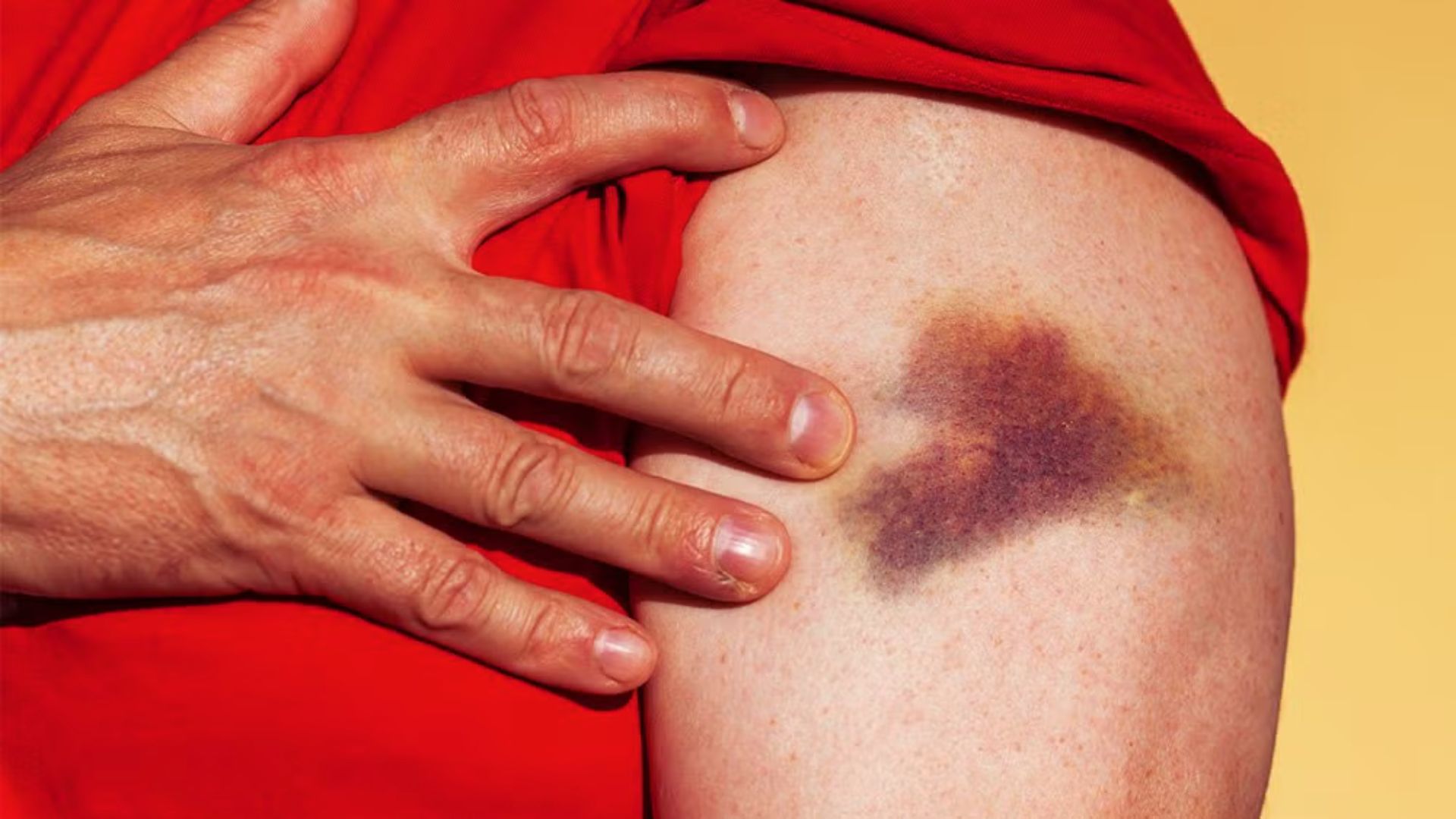 A hand gently touches a large, dark purple bruise on a person's upper arm. The person wears a red shirt against a yellow background, suggesting concern.