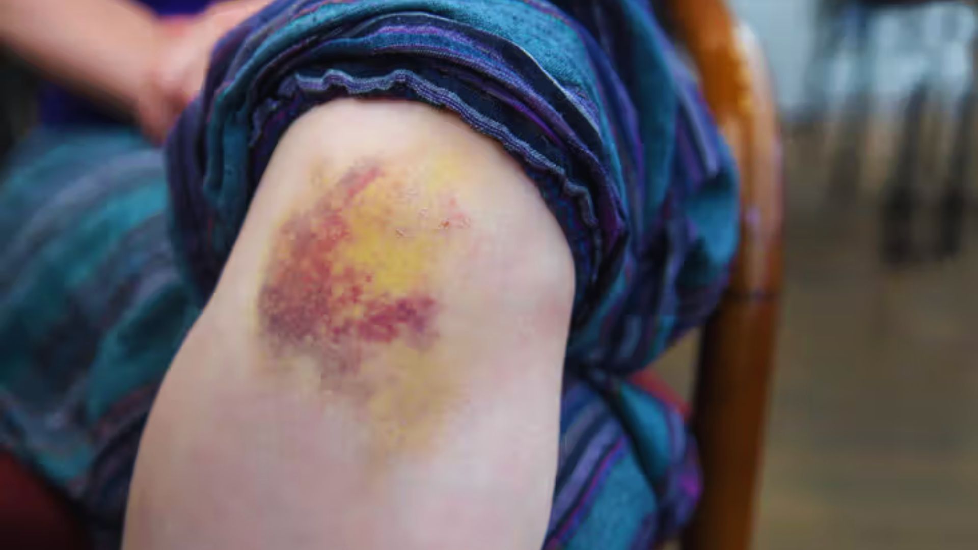 A close-up of a person's knee with a large bruise, displaying shades of purple, red, and yellow. The background shows blue striped clothing and a wooden chair.